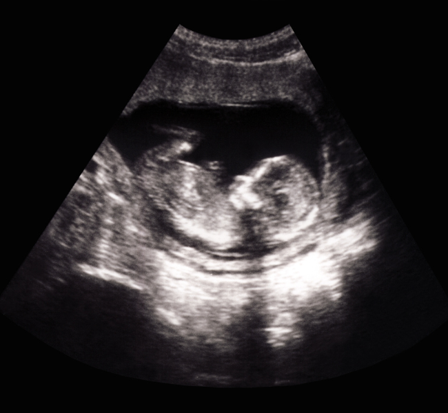 4D Deluxe Peek (26-32 Weeks)